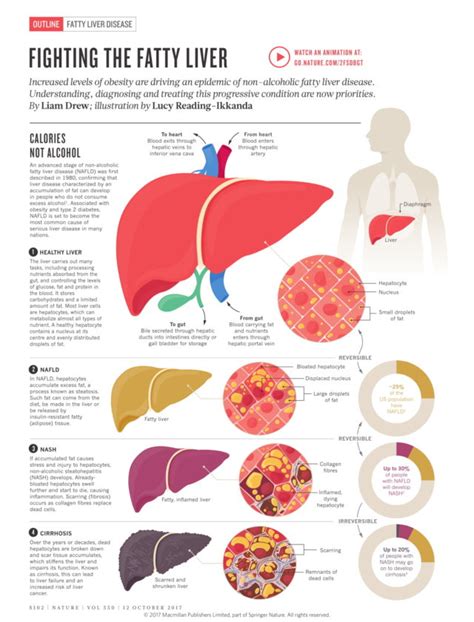 Comparison Of Healthy Liver And Fatty Liver Disease Human Healthcare