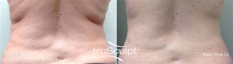 Ts Body1 Skin By Design Dermatology And Laser Center Pa