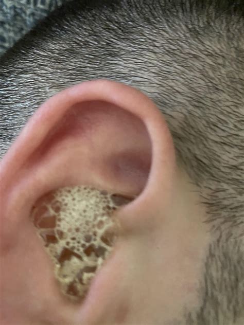 Blocked Ear Peroxide Rearwax