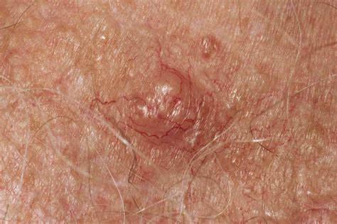 Pictures Of Melanoma And Other Skin Cancers