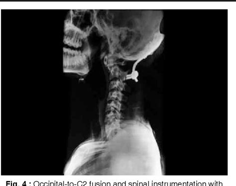 Figure 4 From Old And Neglected Odontoid Fracture With C1 C2