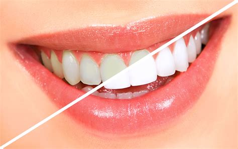 Teeth Whitening Welcome To Lanas Dental Care 239 593 6488