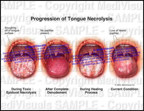Progression Of Tongue Necrolysis Following Stevens Johnson Syndrome