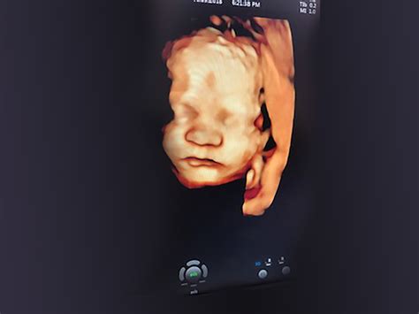 3d 4d Ultrasound Faith Diagnostic Centre