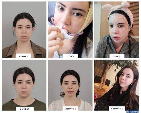 Recovery Process For Facial Contouring Surgery Idhospital