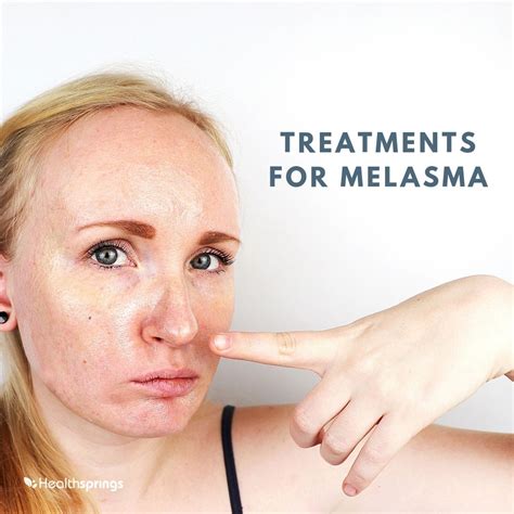 Treatments For Melasma Healthsprings