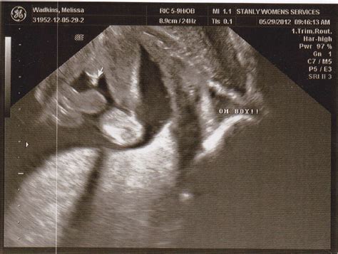 Missys Journal 16 Week Ultrasound Pictures