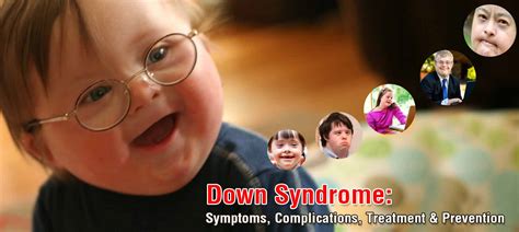 Down Syndrome Symptoms Complications Treatment And Prevention Medplusmart