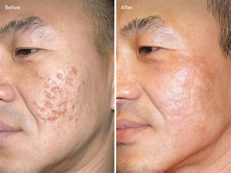 The Best Laser Skin Resurfacing Acne Before And After 2022