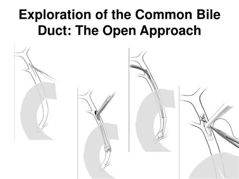 Exploration Of The Common Bile Duct The Open Approach Bile Duct