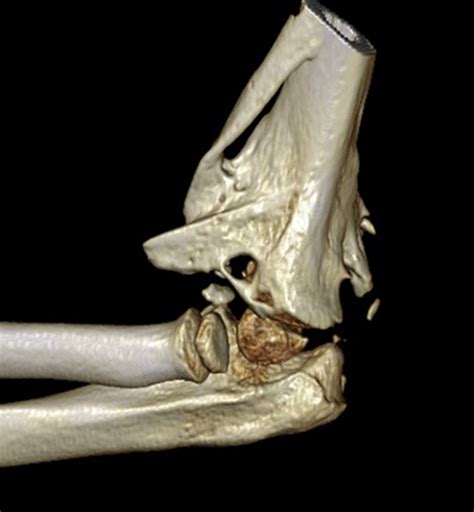 Pediatric Elbow Dislocation Radsource