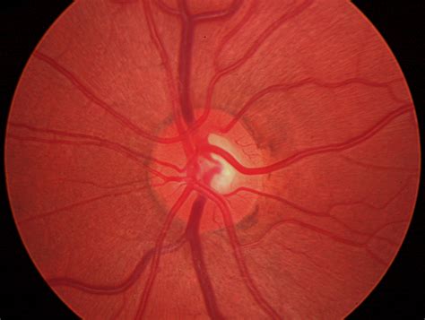 Neuromyelitis Optica Causes Symptoms Diagnosis And Treatment