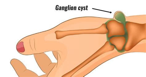 Ganglion Cyst Symptoms Causes Treatment And Surgery