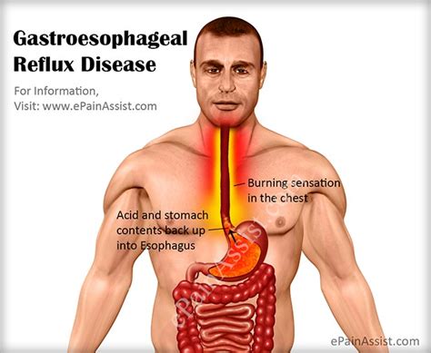 Mayo foundation for medical education gastroesophageal reflux disease and hiatal hernia. Apa itu gerd - Gastro Esophageal Reflux Disease - Olive ...
