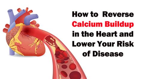 How To Reverse Calcium Buildup In The Heart And Lower Your Risk Of