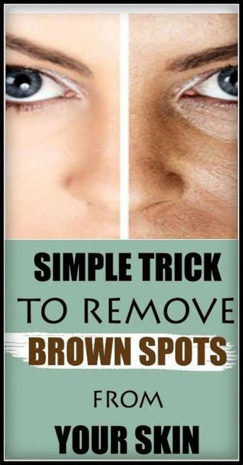 Remove And Prevent Brown Spots With These 2 Natural Ingredients