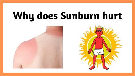 Why Does Sunburn Hurt And Peel Sunburn Youtube