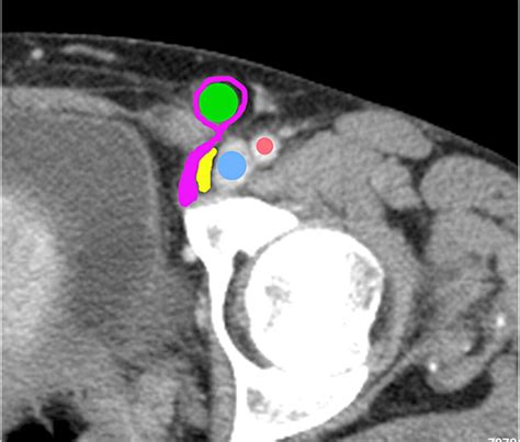 Diagnosis Of Inguinal Region Hernias With Axial Ct The Lateral