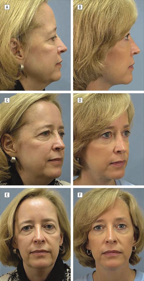 evolution of midface rejuvenation jama facial plastic surgery the jama network