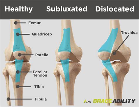 Patellar Subluxation Partially Dislocated Kneecap Subluxation Knee