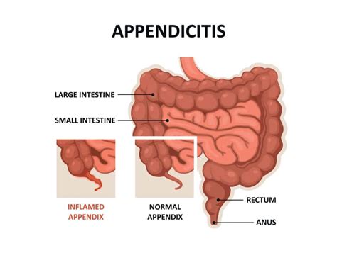 Appendicitis Drug Genius