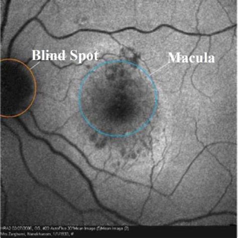 Auto Fluorescence Image Of Retina In Which Optic Disk And Blind Spot
