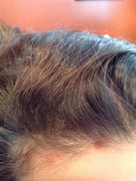 Red Spots On Scalp Pictures Photos