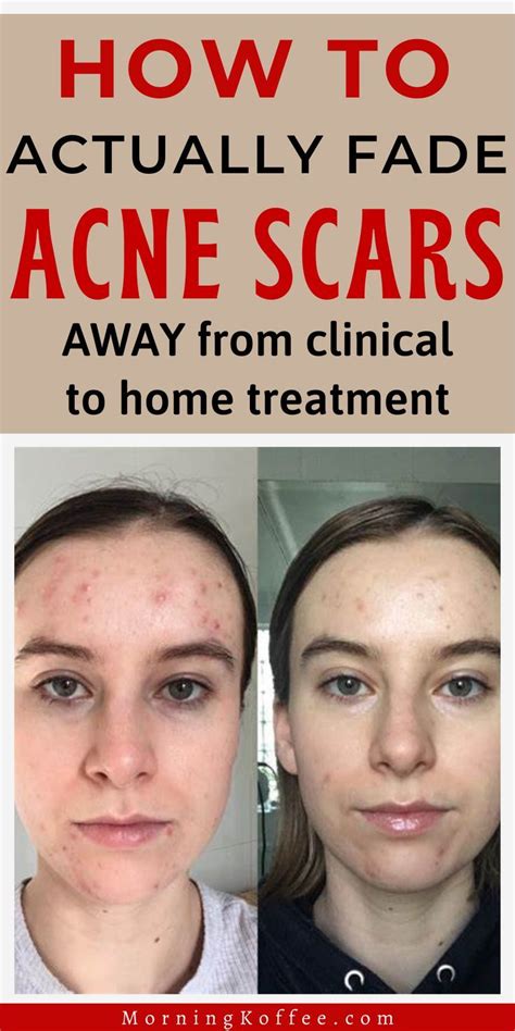 How To Get Rid Of Acne Scars Fast Artofit