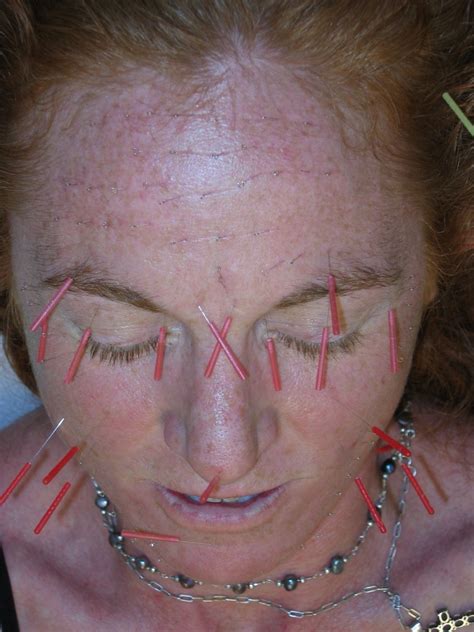 Facial Rejuvenation Cosmetic Acupuncture Luvlight Acupuncture