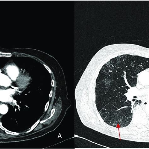 Panel A Ct Thorax Showing Right Sided Hilar Lymphadenopathy Panel B