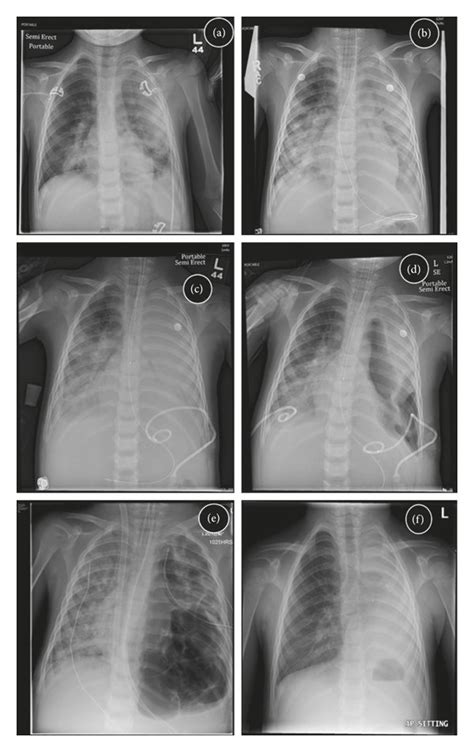 Chest Radiographs Showing Progression Of Disease A Presentation To