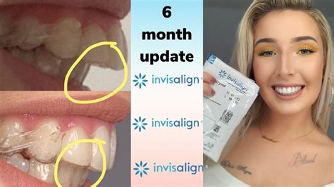 Invisalign Overbite Correction 6 Month Update With Before And After