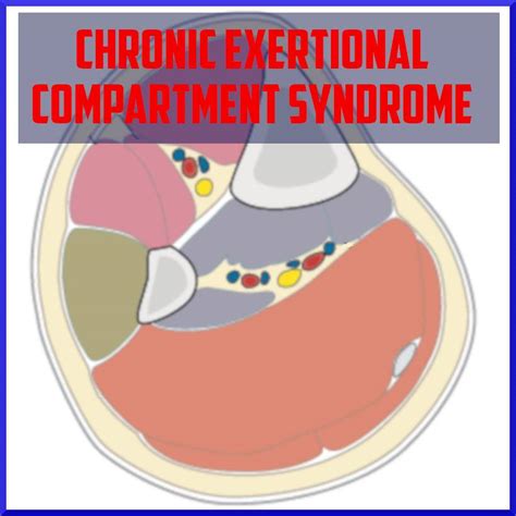 Chronic Exertional Compartment Syndrome In The Lower Limb Sports