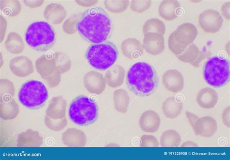 Lymphocyte Cells In Blood Smear Stock Image 126098983