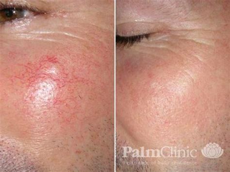 Rosacea And Facial Vein Removal Before And After Photos Palm Clinic