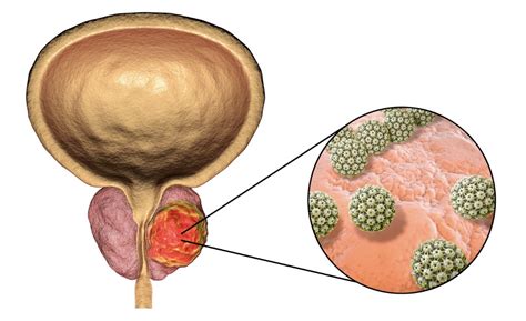 Prostate Cancer What To Know