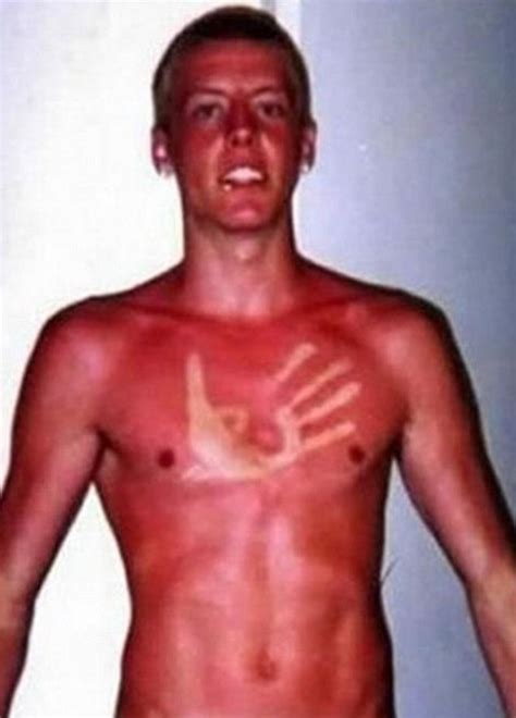 Are These The Worst Sunburn Fails Ever Daily Mail Online