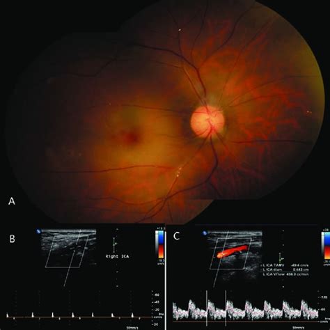 Ct Angiography Cta Demonstrates Severe Carotid Artery Occlusion