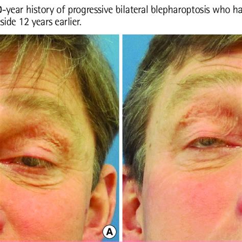 PDF Treatment Of Eyelid Ptosis Due To Kearns Sayre Syndrome Using