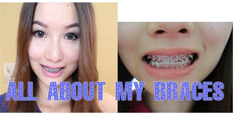 Braces Vlog 7 Months Brace Update Overbite Picture Before And After