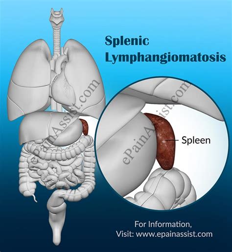 Splenic Lymphangiomatosiscausessymptomstreatmentdiagnosis