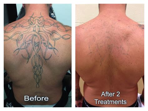 Laser Tattoo Removal Before And After All You Need Infos