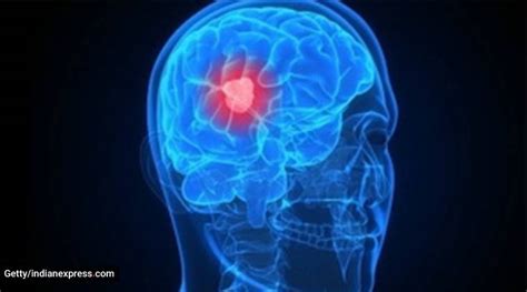 World Brain Tumour Day 2020 All You Need To Know About Brain Tumours