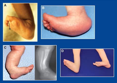Foot And Ankle Deformities Musculoskeletal Key