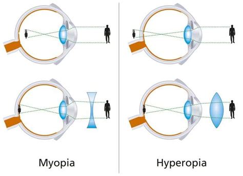 Diagram Myopia Hyperopia Diagrams Mydiagramonline