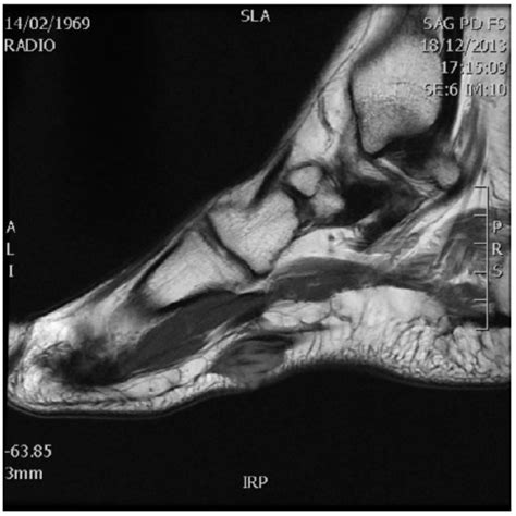 The plantar fascia connects the bottom of the heel bone to the ball of the foot and is essential to walking, running, and giving spring to the step. MRI of the right feet: sagittal T1-weighted image demon | Open-i