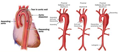 Aortic Dissection Doctor