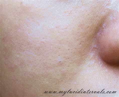 Dry Skin Patches On Face Pictures Photos