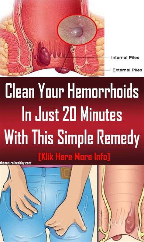 clean your hemorrhoids in just 20 minutes with this simple remedy health tips hemorrhoids