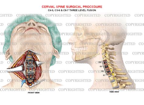 C4 C7 Cervical Plate Fusion 3 Level — Medical Art Works